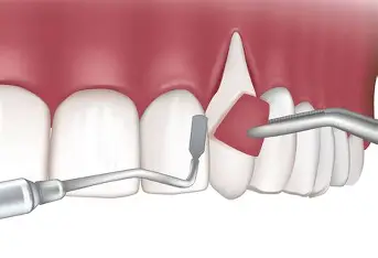 Gum Disease Treatment