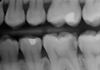 Dental X-Ray
