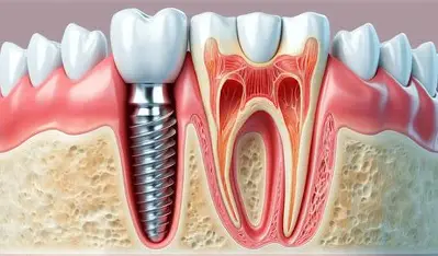 Dental Implants